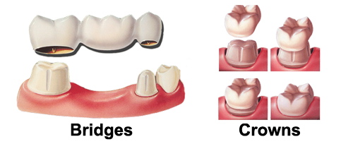 crown-bridge