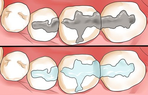 rootcanal