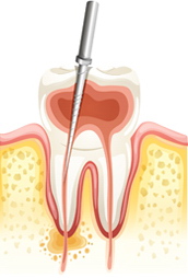 rootcanal