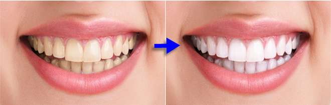 Tooth Whitening/Cosmetic Dentistry